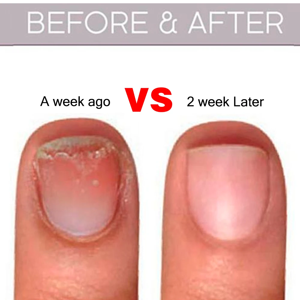 Lovcarrie Cuticula Olie Voor Nagels Kunstbehandeling 20Ml Voedingsformule Proteïne Nagel Reparatie Etherische Olie Serum Voedingshulpmiddelen