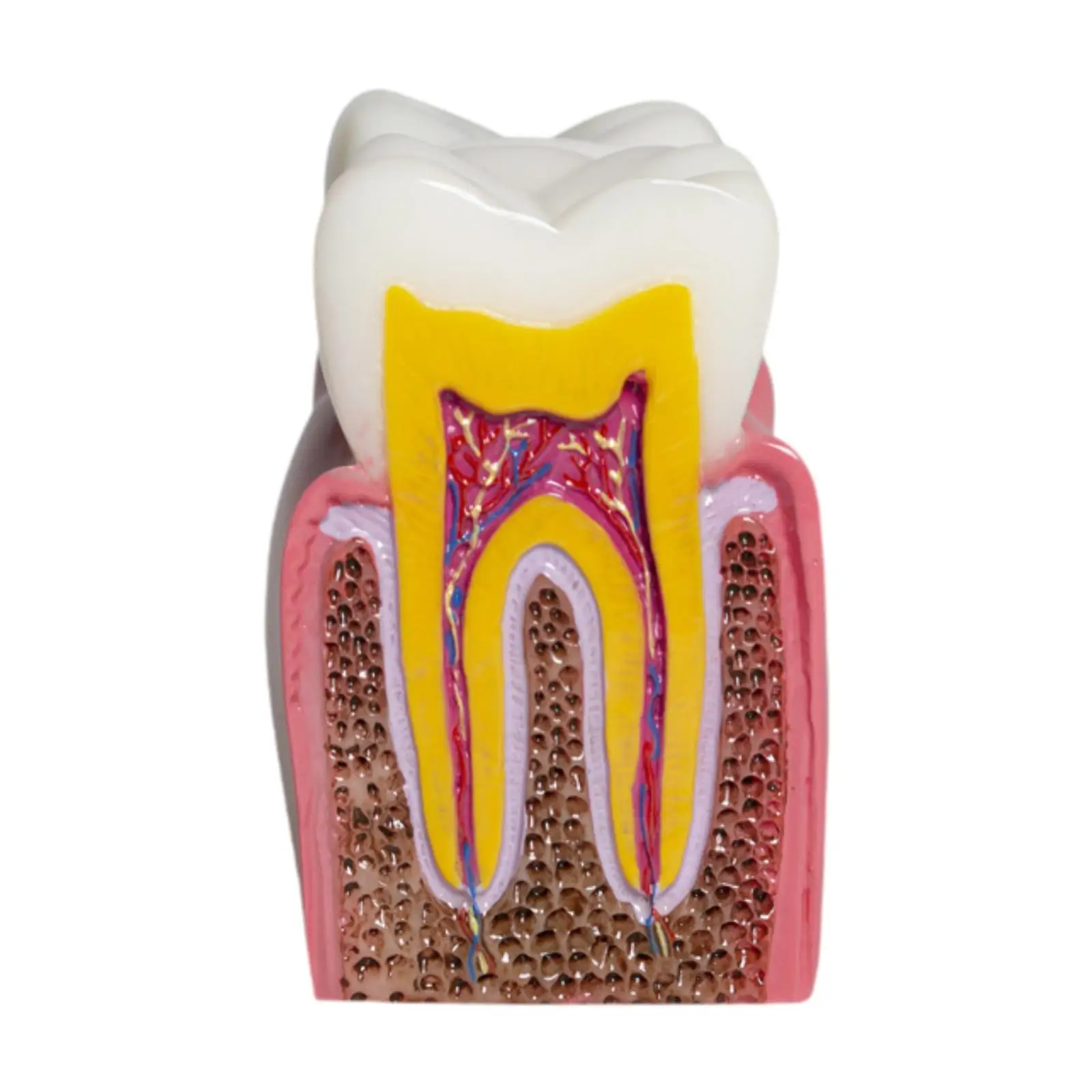 6 Times Caries Tooth Model Resin Caries Structure Detailed Teaching Aid Decay Tooth Comparative Study Model for Students Kids