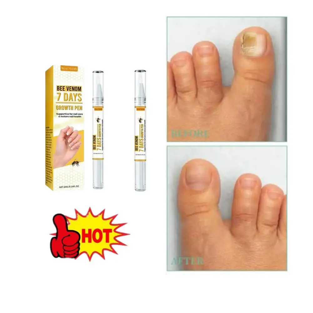 2 pçs 7 dias solução de reparo de unhas de abelha reparação tratamentos de fungos nas unhas essência anti infecção cuidados com os pés