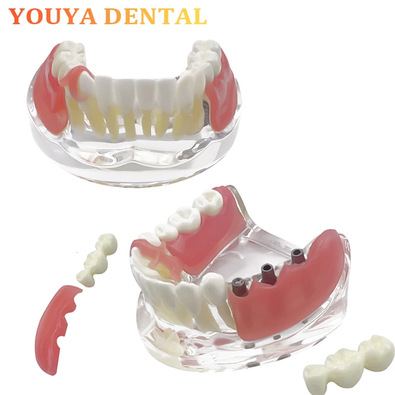 

Модель зубного имплантата промысловной 3, съемная модель зубного протеза, модель стоматологической медицинской лаборатории, обучающая модель