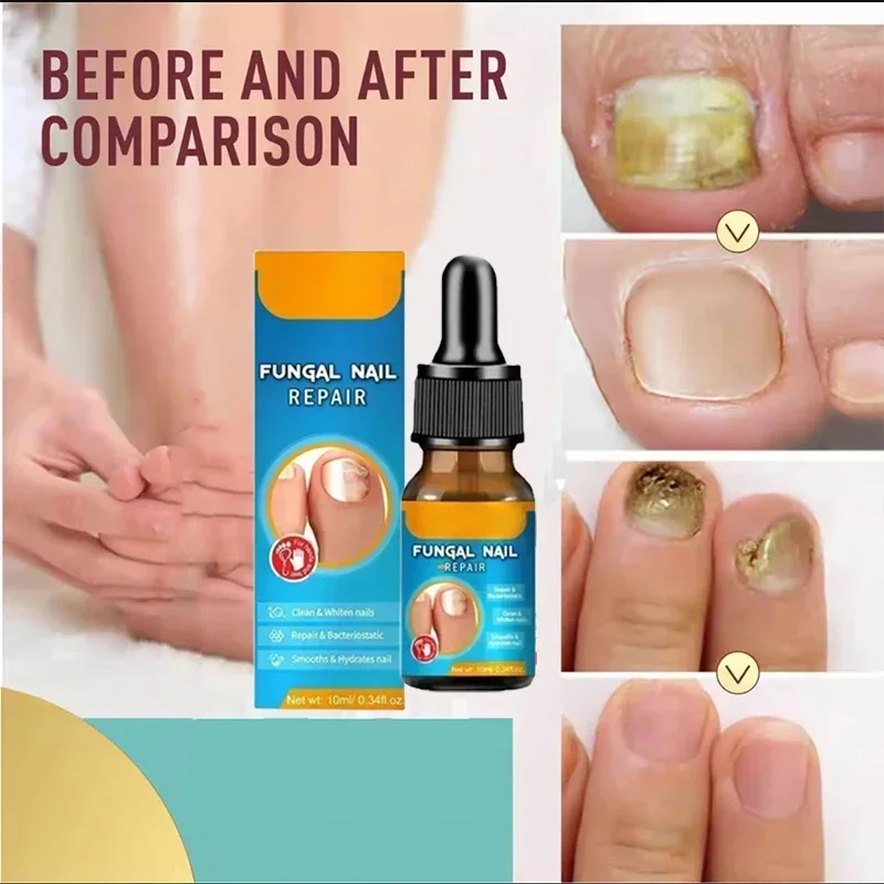 Nail Fungus Treatment Oil Fast-acting Soften Nail Treatment Oil for Weak Cracked Split Nails High Quality Durable