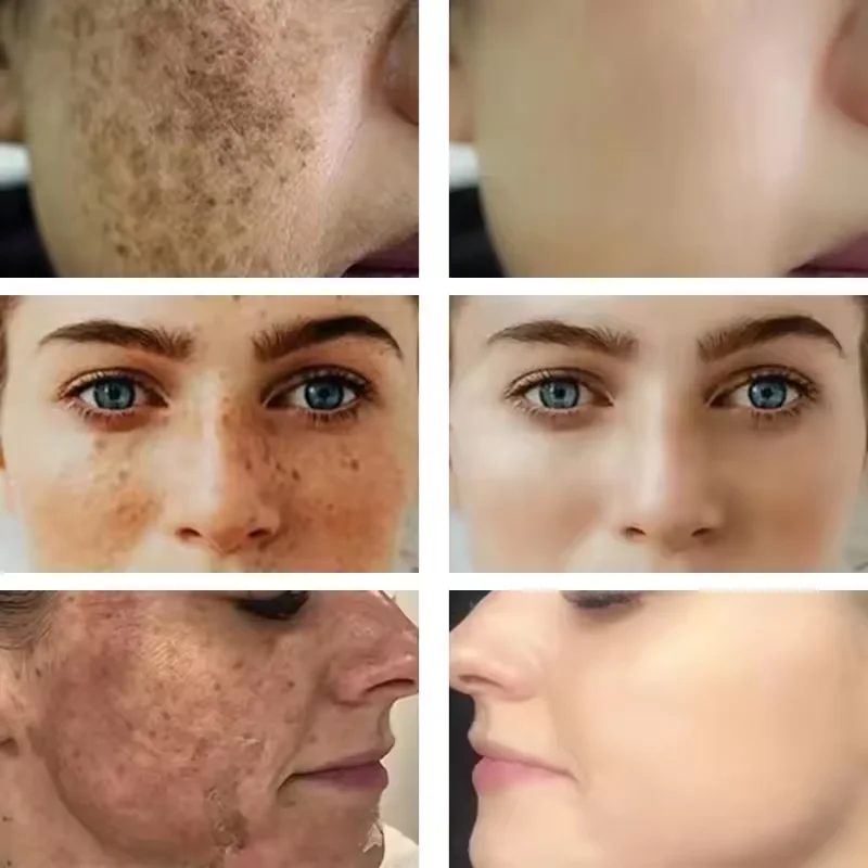 Vitamin E Dark Spots Remover Capsule ﻿Face Freckle Melanin Correct Anti Pigmentation Brighten Beauty Korean Day Night Skin Care
