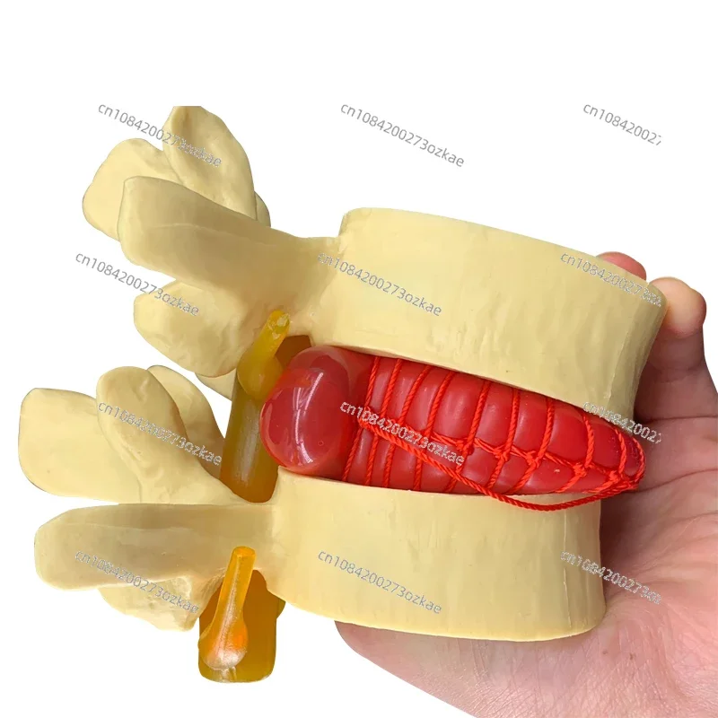 Lumbar Enlargement Demonstration Model of Lumbar Intervertebral Disc Compression Human Spine Vertebral Pathology Demonstration