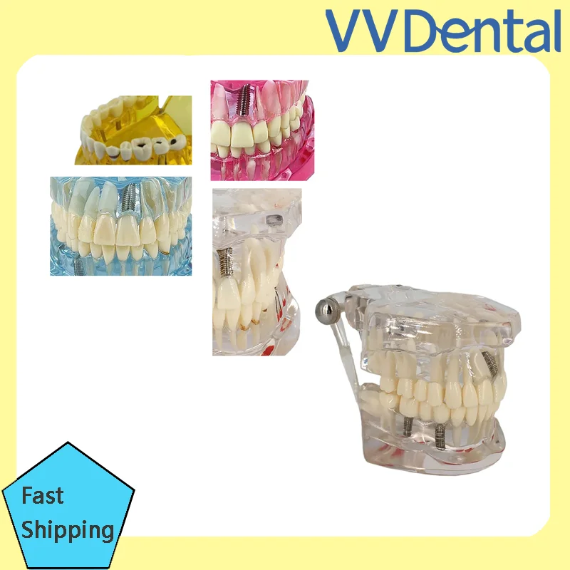 VVDental Repairable Resin Diseased Teeth Models Realistic Dental Disease Simulators for Medical And Dental Education & Research