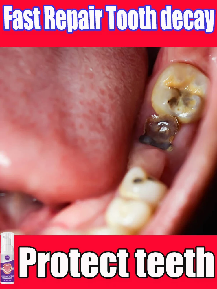 

Decay tooth cavities healing anti caries