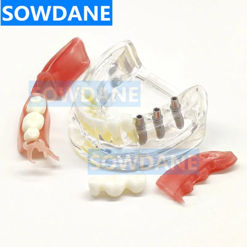 Dental Lower Teeth Implant Model with Restoration Dental Prosthesis Model For Dentist Patient Communication Treatment Study Demo