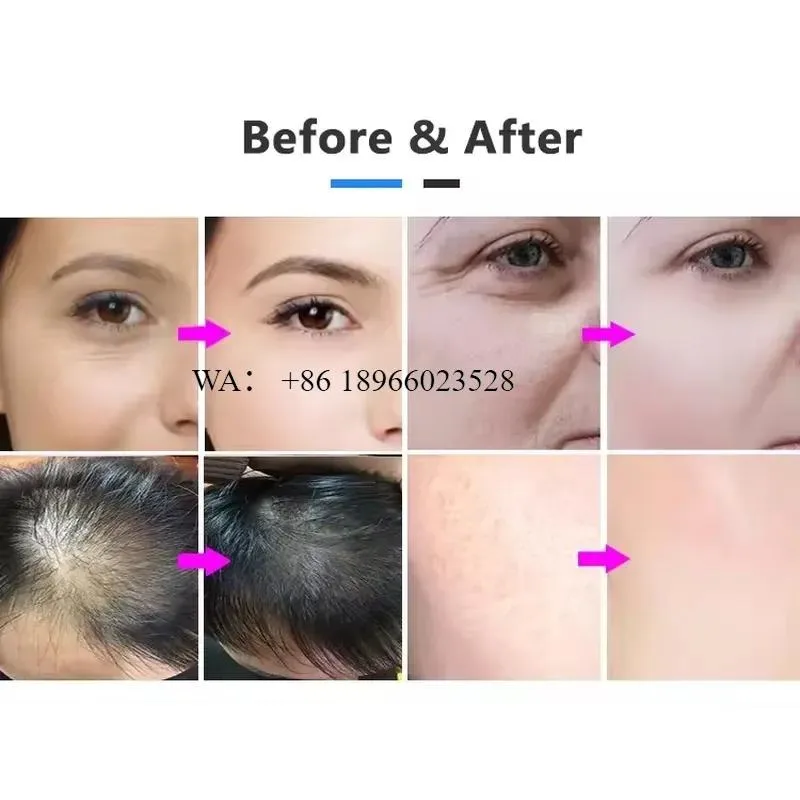WMWMNU Newest Portable Needle-free Mesotherapy Instrument Improves Nutrient Penetration for Home Use Beauty Device view 2