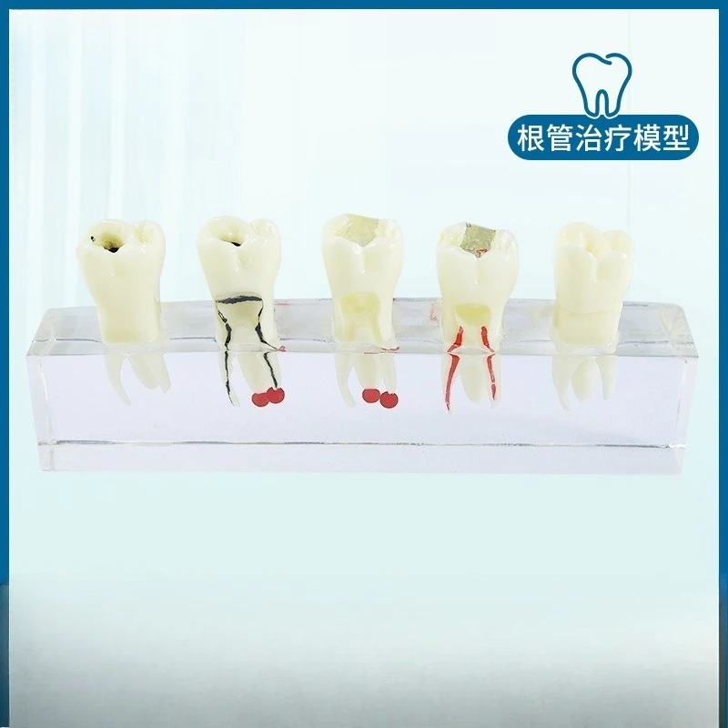 Root canal therapy model teaching transparent removable tooth nerve tooth root observable tooth