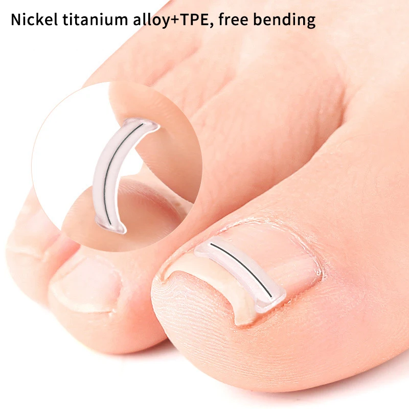 2Pcs Nagel Korrektur Aufkleber Eingewachsene Zehennagel Corrector Patches Paronychie Behandlung Erholen Corrector Pediküre Werkzeuge Fuß Pflege