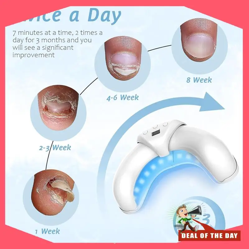 24-часовая доставка, лечение грибка ногтей, лечение грибка пальцев ног, лечение грибка ногтей на ногах, устройство для лечения грибка ногтей