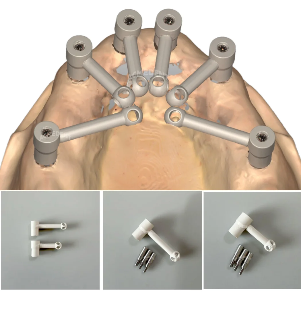 intraoral-photogrammetry-scanning-dental-scanbody-long-short-full-denture-scan-body-universal
