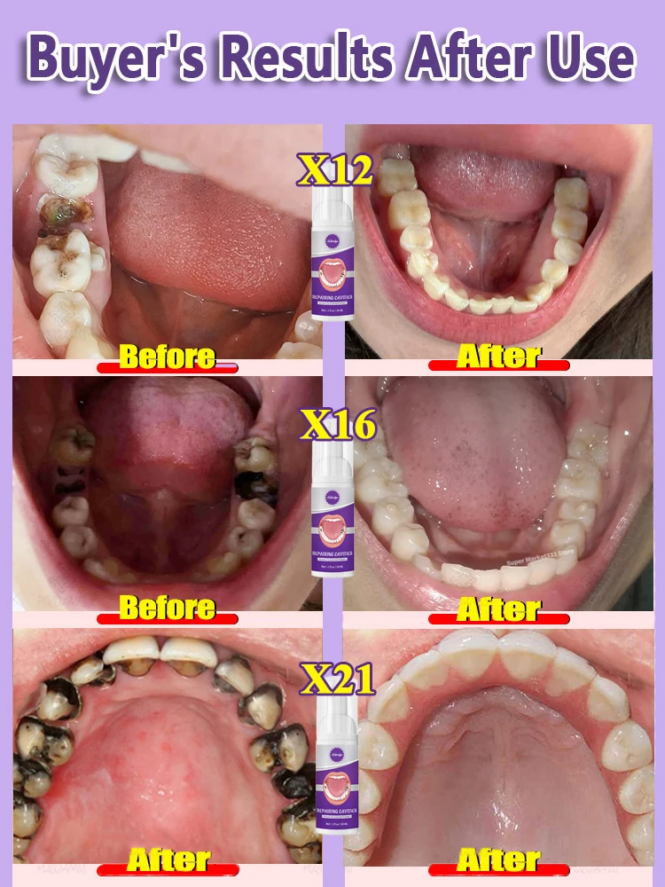 Dentes Decay reparação