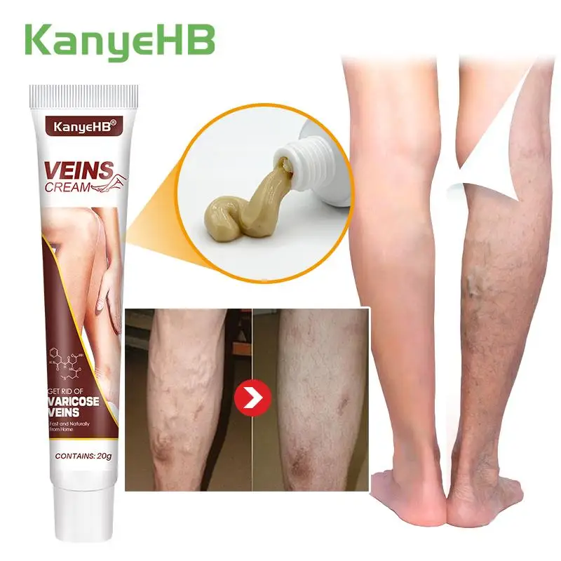 1pc Varicose Veins Cream Treatment Vasculitis Phlebitis Feet/Leg Body Spider Shape Varicose Veins Remover Medical Plaster G032