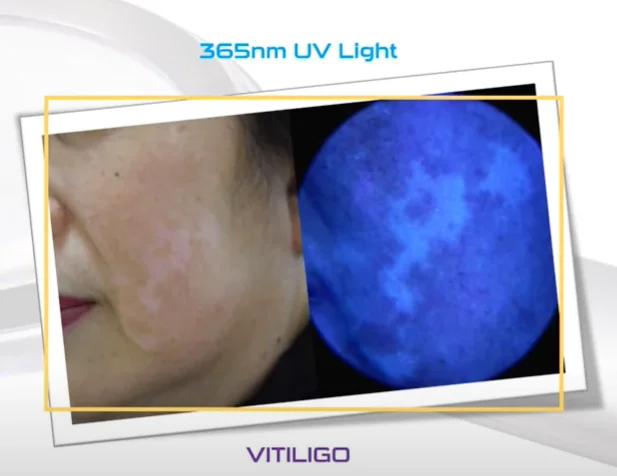 Machine à lampe en bois pour analyse qualifiée ale, analyseur de peau, lampe à ultraviolets, examen de la peau UV, test de beauté, grossissement du visage, lampe vitiligo