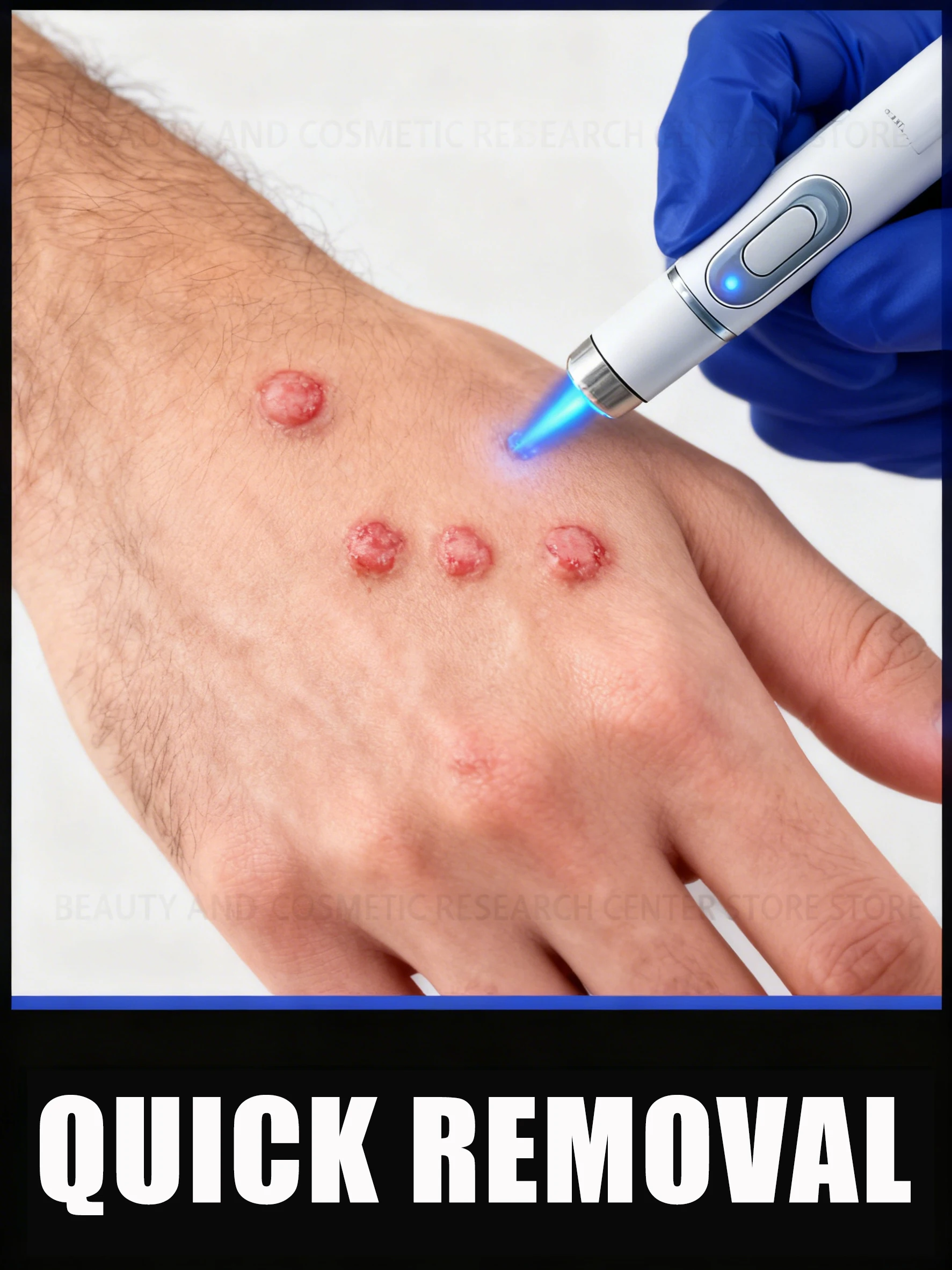 قلم إزالة W- آمن وفعال، يقع الثآليل تلقائيًا، 2026 #1