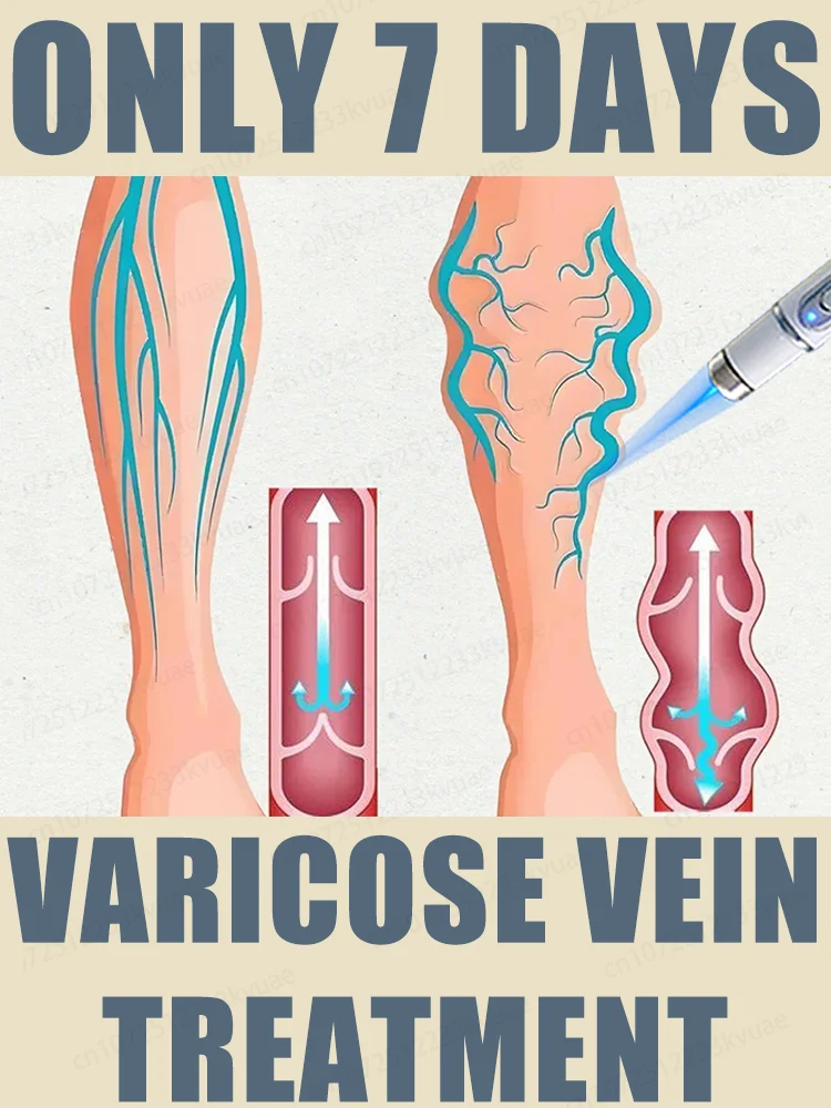

2nd generation laser venous treatment pen, used to treat varicose veins