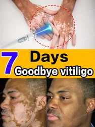 Laser Pen Removes Vitiligo