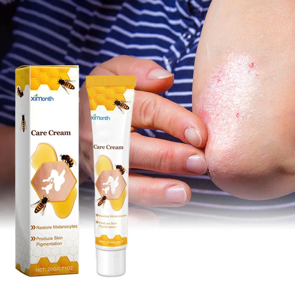 Vitiligo Tratamento Bee Cream, spray de alívio, tratamento da pele lâmpada, mancha branca remoção pomada, eliminar vitiligo