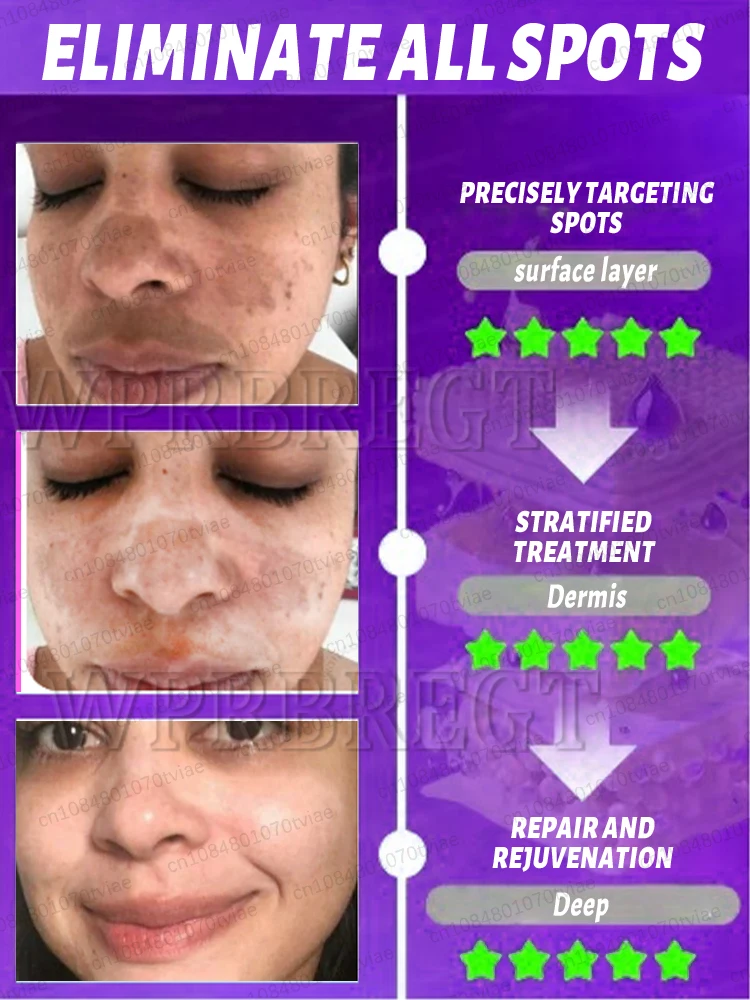 〔Hot sale〕Effectively solve the problem of ᴘɪɢᴍᴇɴᴛ ᴀᴄᴄᴜᴍᴜʟᴀᴛɪᴏɴ and say goodbye to pigmentation