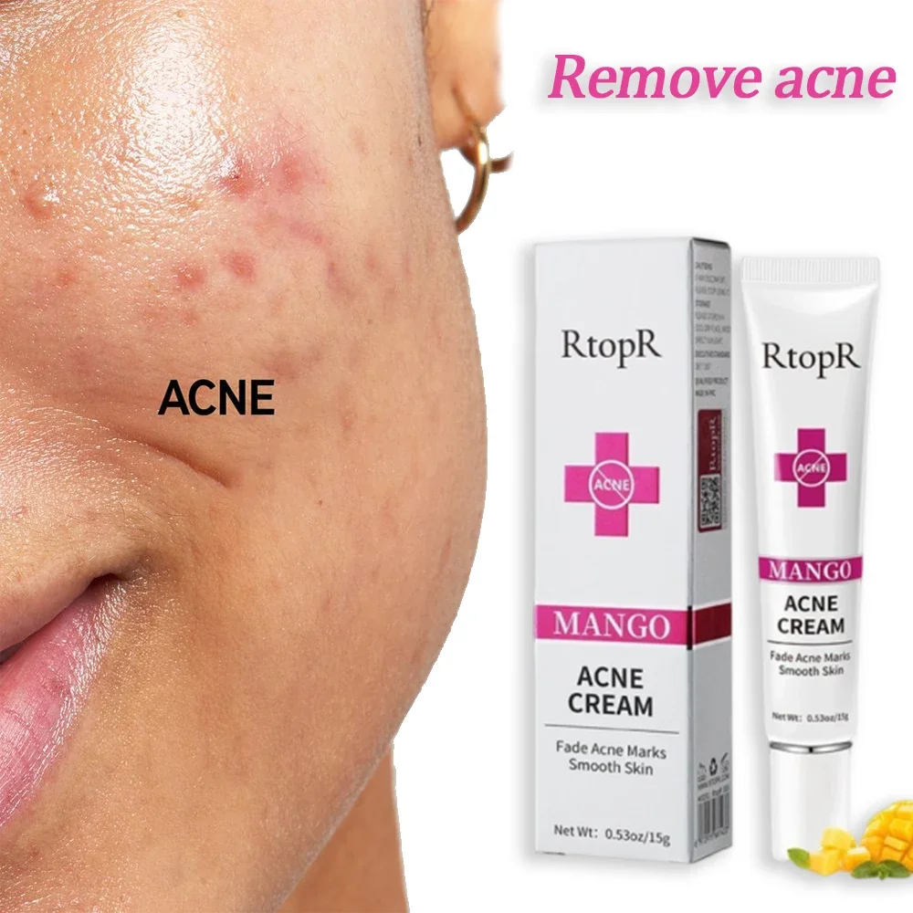 Acne Removal Cream Acne Mark remover Acne Mild Repair Damaged Hydration Nourishment Rejuvenation face Brightening Skin Care