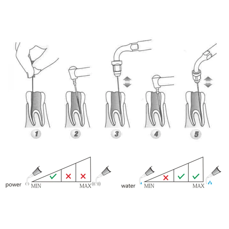 Matériel dentaire pour dentiste, pointe endo pour dents, livres de canal radiculaire antérieur, ajustement EMS, pic de calcul, outils de détartreur à ultrasons, E2, chaud, 5 pièces