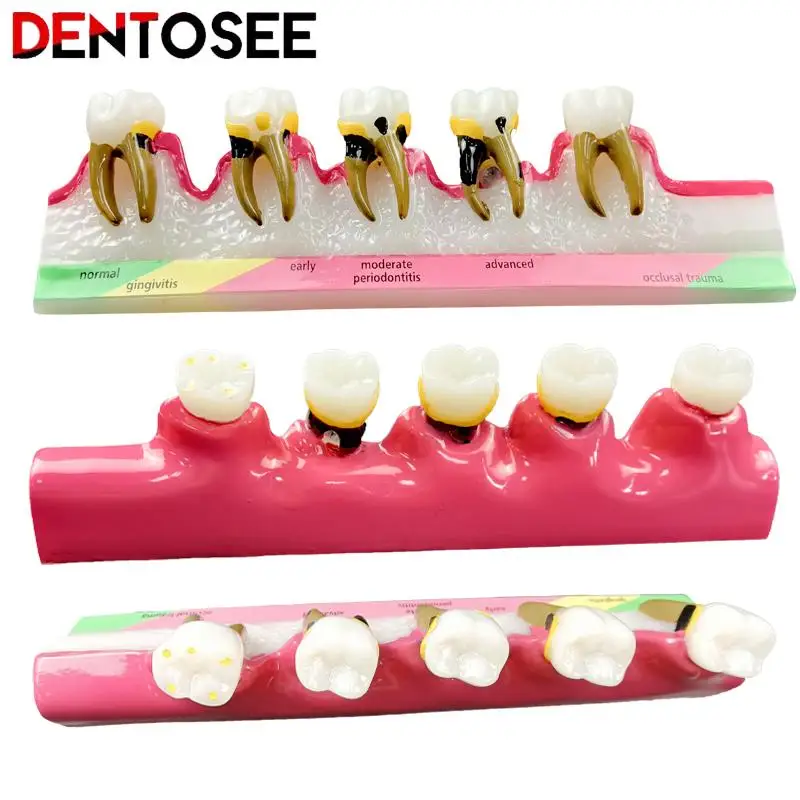 Dental Periodontal Disease Assort Demo Teeth Model 5 Stage Three-Dimensional Proportional Magnification Design for Dentist