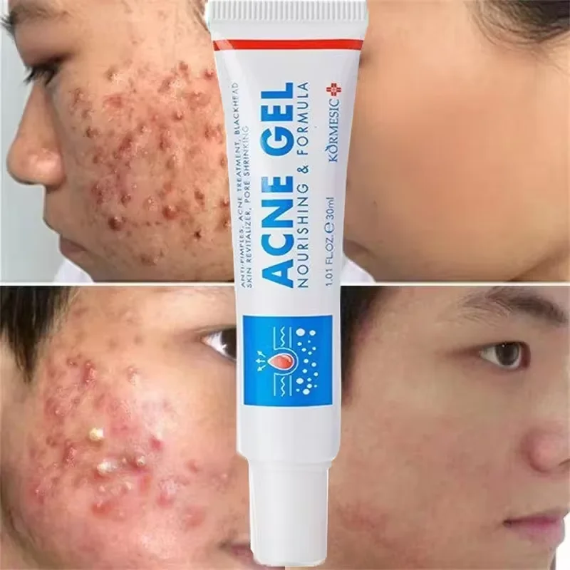 Salicylic Acid Acne Treatment Face Cream Repair Pimple Spots Deep Cleaning Pore Anti-acne Scar Oil Control Moisturizer Skin Care