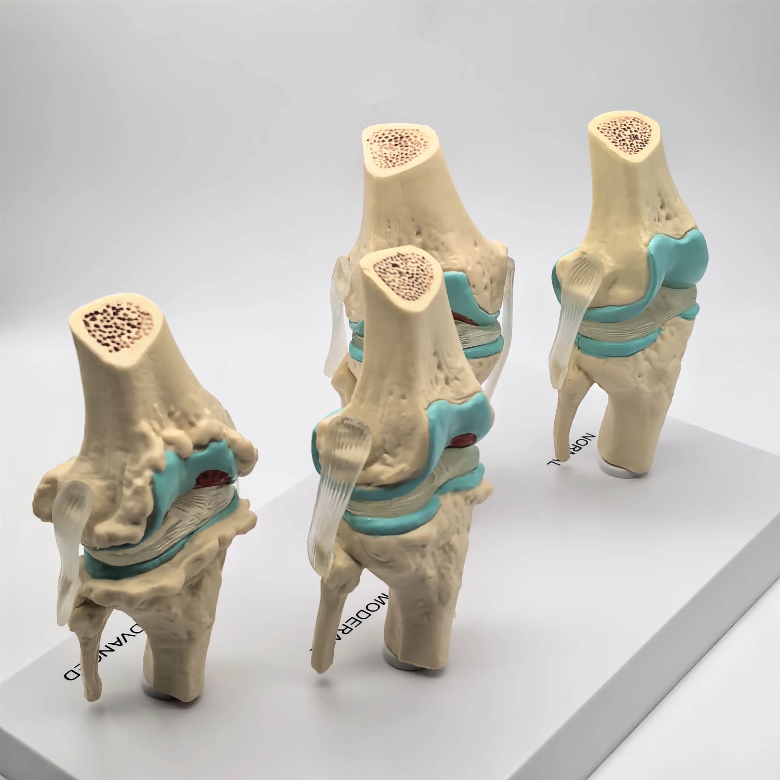 نموذج مرض مفصل الركبة التشريحي البشري المزخرف تشريح الهيكل العظمي الطبي موارد التدريس PVC #4