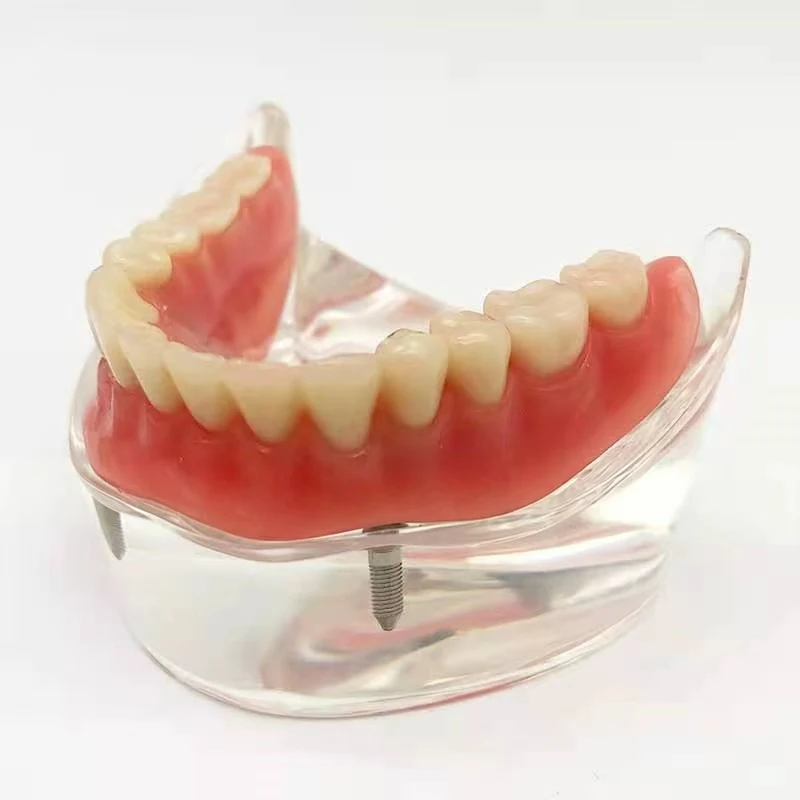 Life Size Human Teeth Dental Implant Display Teeth Oral Anatomical Model Dental Restoration Teaching Model