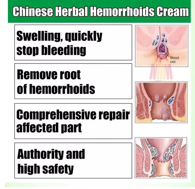 Hemorrhoids Treatment Cream Herbal Cream Mixed External Internal Anal Fissure Pain Relief Treatment Cream Health Care