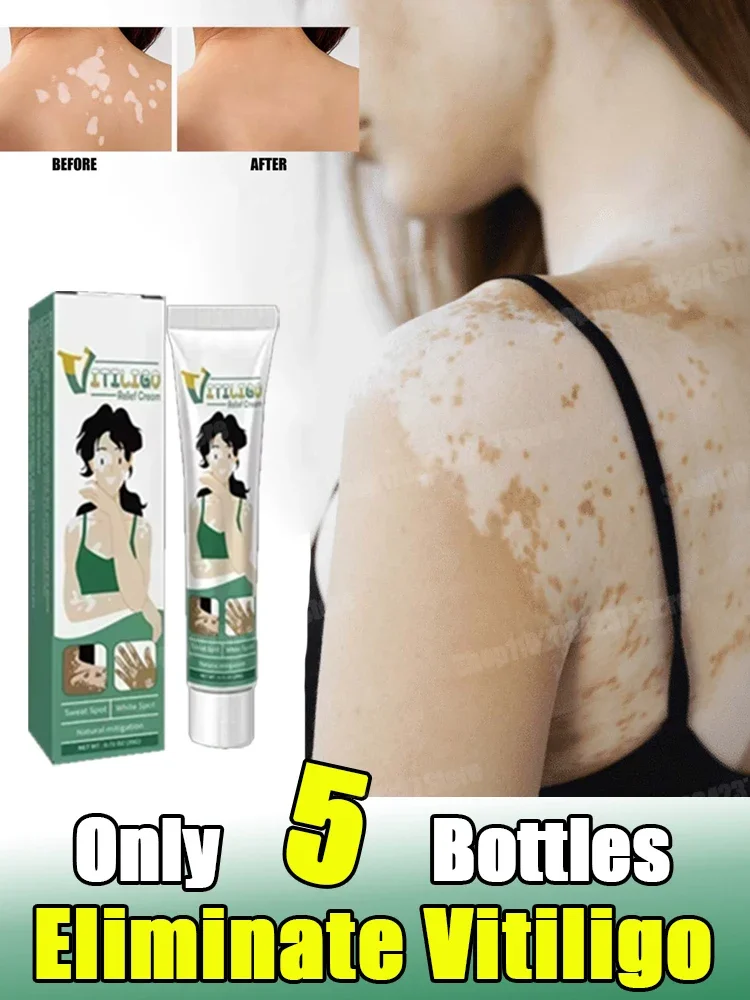 Vitiligo Remove Ringworm White Spot Gel Removal Skin Vitiligo Eliminate Vitiligo Externe Hautpflegecreme