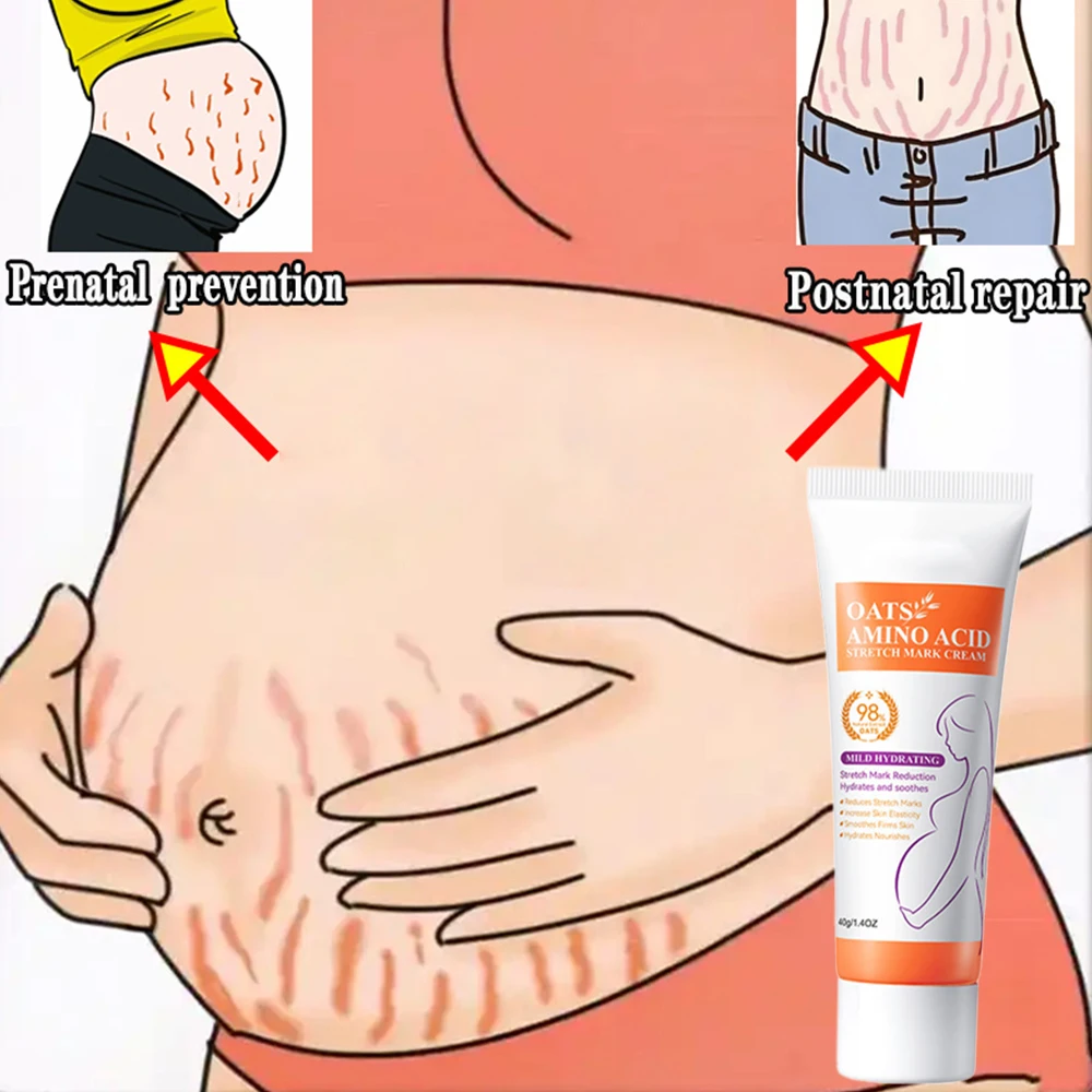 

Stretch Marks Remover Light Lines Postpartum Obesity Pregnancy Cream Powerful Formula