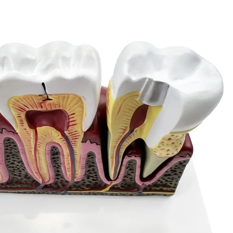 أمراض الأسنان هيكل تشريحي نموذج طبي لتدريس دراسة علاج قناة الجذر مظاهرة أسنان طبيب الأسنان #3