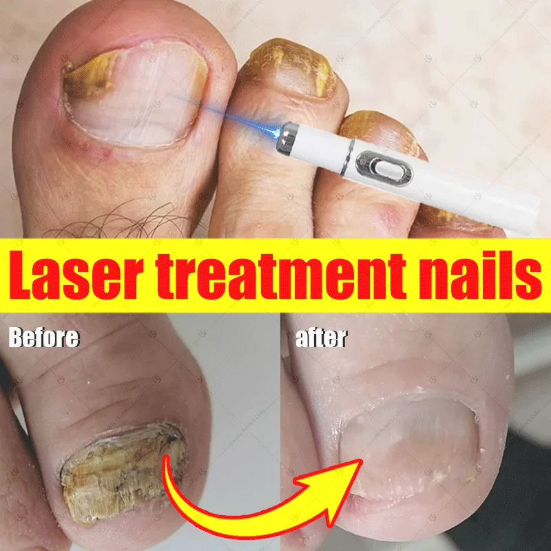 

Nail Treatment Laser Pen Painless Anti Fungus Infection Fungal Removal Laser Onychomycosis Care Strong Grow Toe Nail Repair Tool