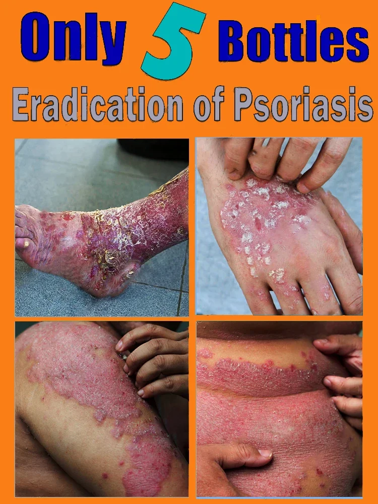 Рисунок 2 - Крем от псориаза