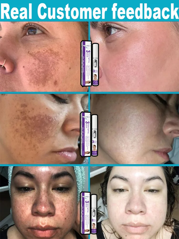 Laser Therapy to Heal Spots
