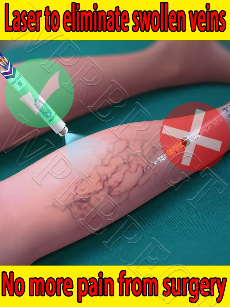 

Laser Elimination of Vasculitis and Phlebitis, Relief of Spider Leg Pain