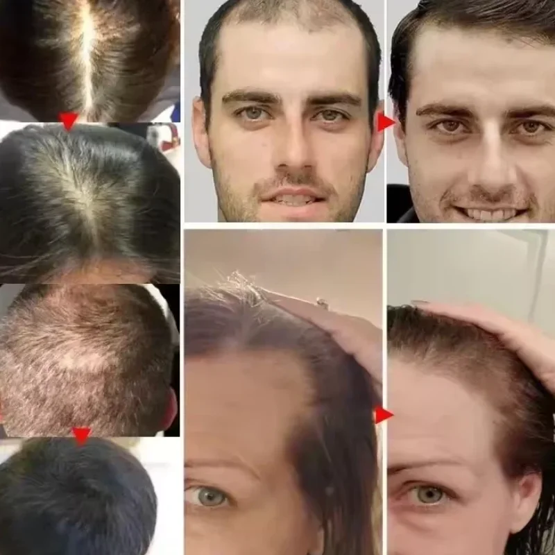 

Wireless Hair Growth Laser Helmet, Red Light Therapy Cap for Men and Women Hair Loss Treatment