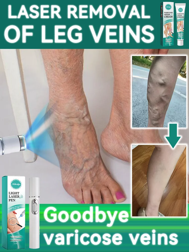 Blue laser heals leg veins