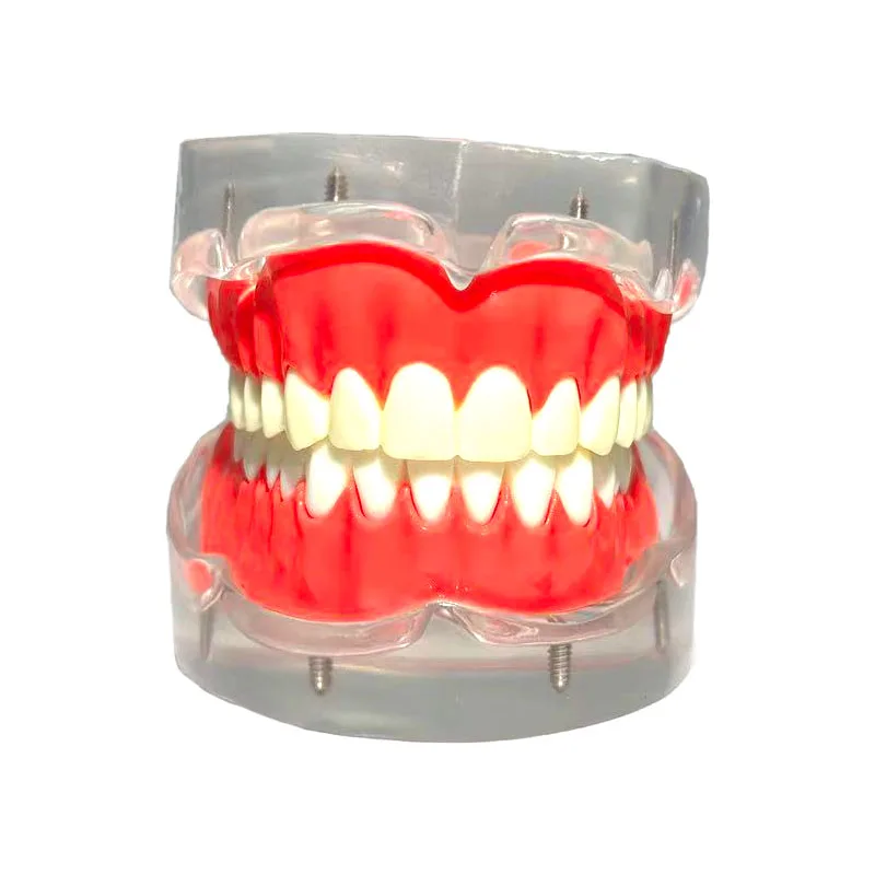 1Pcs Dental Implant Model Maxillary Mandibular Removable 4 Implant Overdenture Restoration Teeth Model Demonstration Model