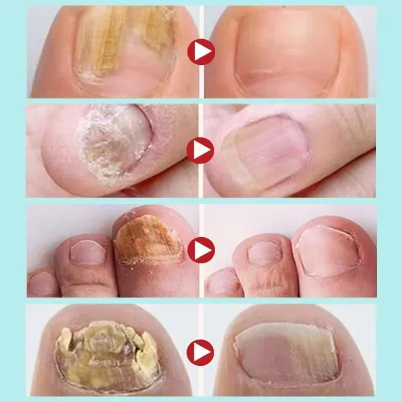7 giorni Trattamento Fungo Delle Unghie Siero Riparazione Unghie Dei Piedi Rimozione Fungine Essenza Anti Infezione Paronichia Onicomicosi Assistenza Sanitaria