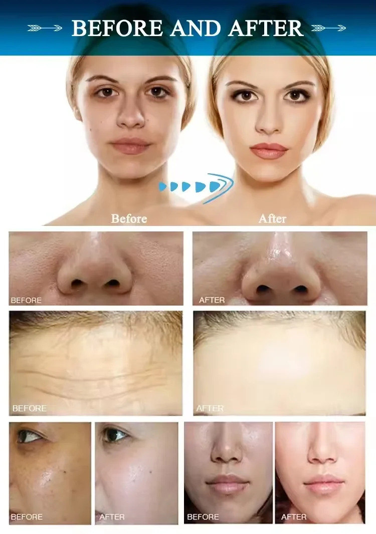 2025年式 酸素セラピー フェイシャル ジェットピールマシン 新デザイン ウォーターダーマブレーション しわ除去 美白美顔器