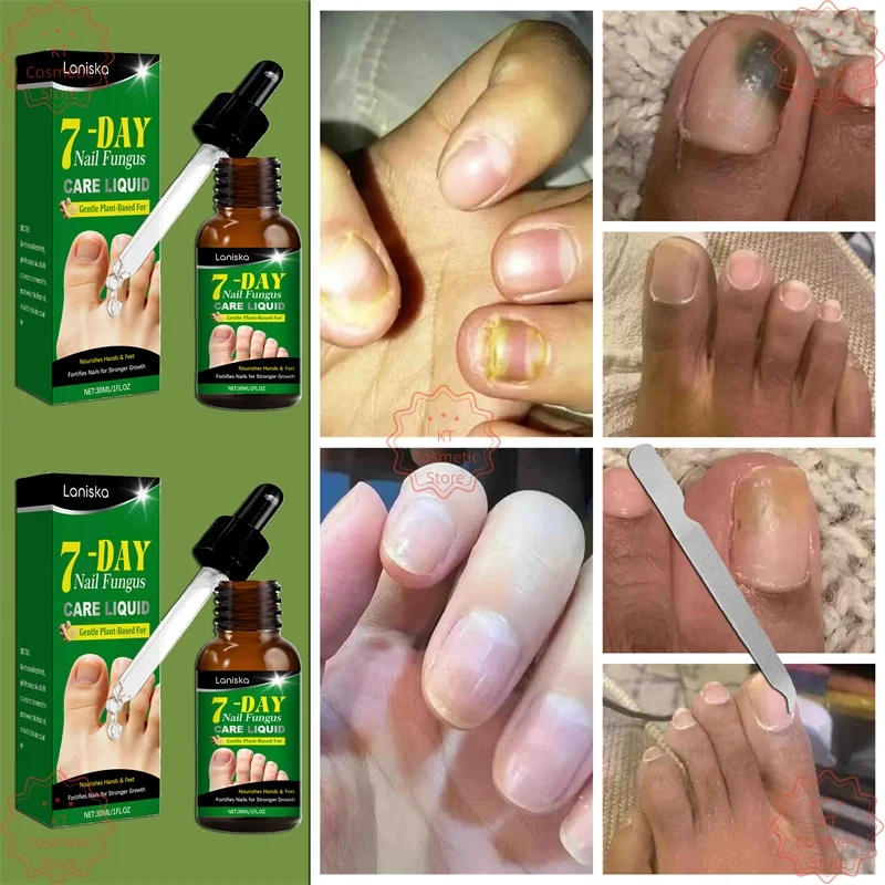 مصل إصلاح فطريات الأظافر إزالة فطريات الأظافر زيت طبيعي مضاد للعدوى فطار الداحس إصلاح الرعاية 30 مللي