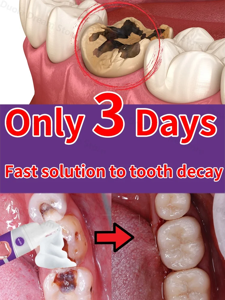 3 Days Fast Effective Teeth Whitening Tooth Decay Repair Calculus Plaque Periodontitis Remove Cavities Toothpaste Pen