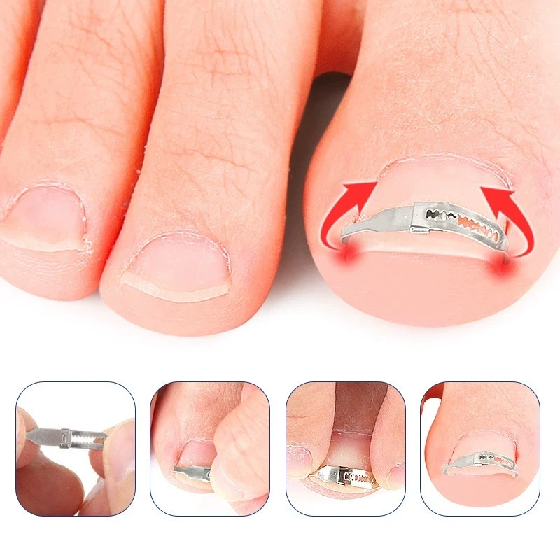 1PC Ingrown Toenail Corrector Tools Pedicure Recover Embed Toe Nail Treatment Professional Ingrown Toenail Correction Foot Care