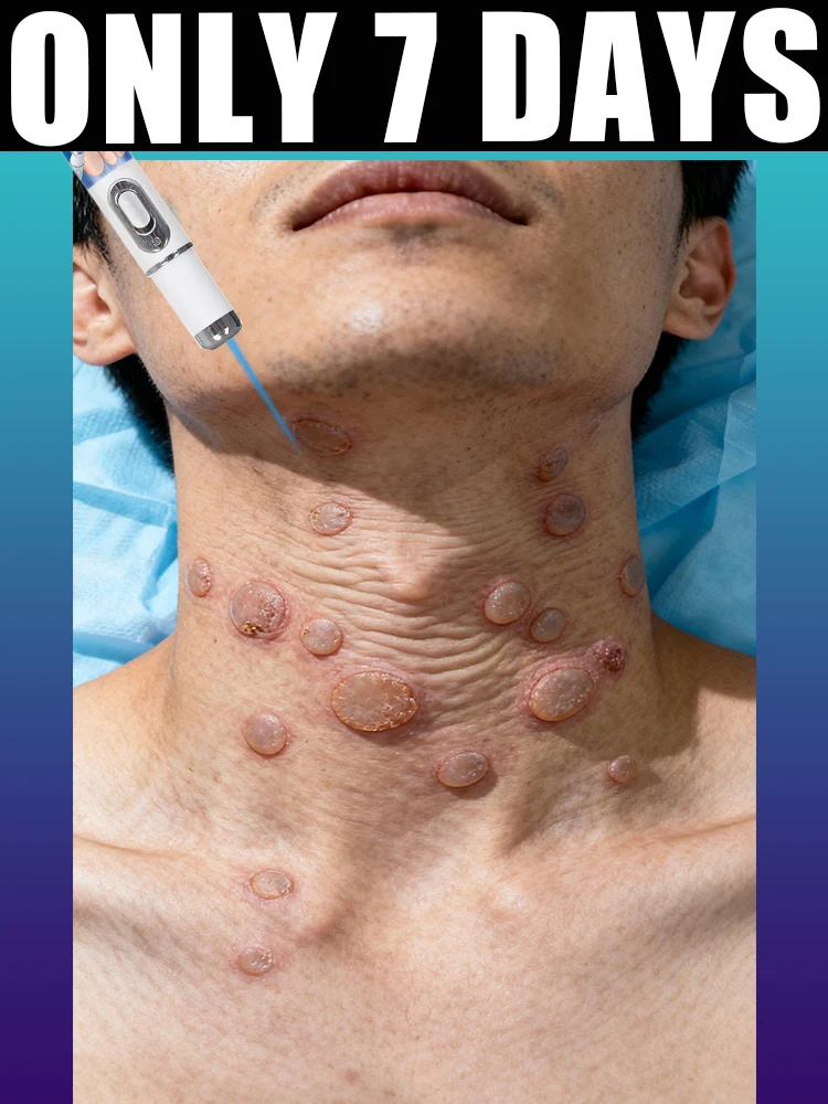 

Professional Blue Light Laser Pen for Targeted Skin Care