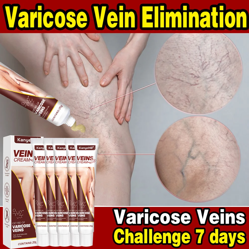 Varicose Vein Treatments Cream Effective Relieve Legs Dilated Vasculitis Phlebitis Spider Legs Natural Formula Ointment