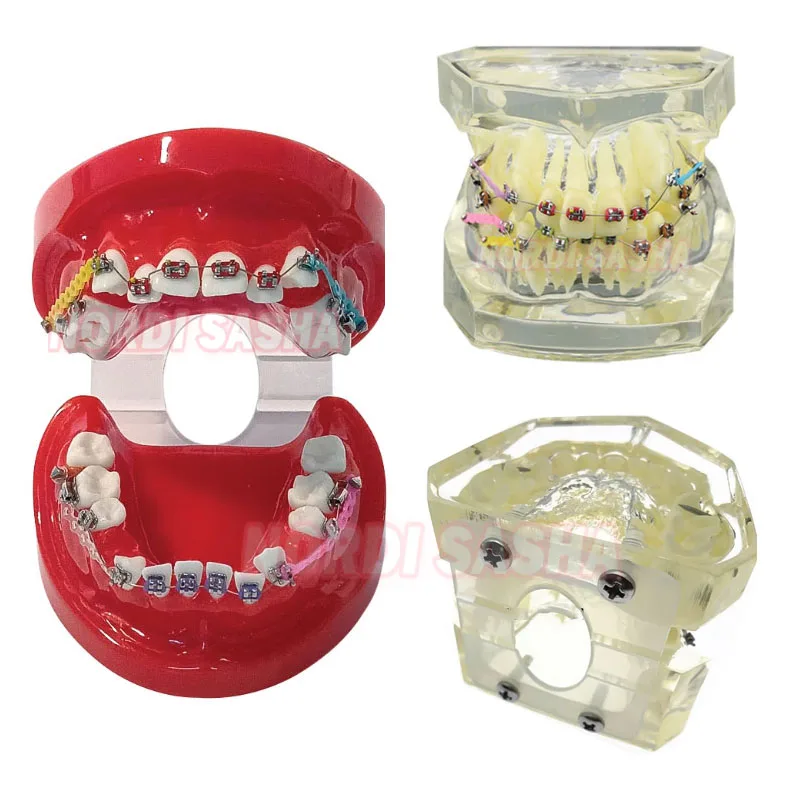 1Pcs/Box Dental Orthodontic Standard/Malocclusion Teeth Model With Metal Brackets Red /Transparent Demonstration Typodont Model