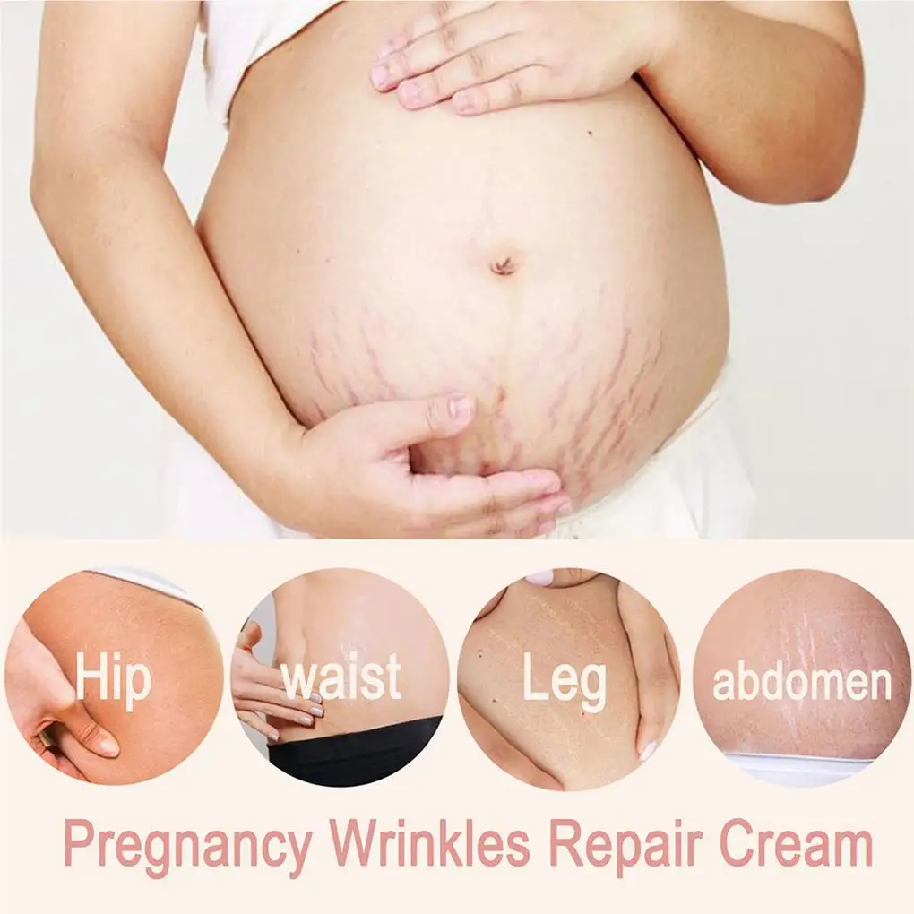 Women Stretch Mark Cream Pregnancy Wrinkles Comfortable Beauty Tools Safe Scars Remover Home Waist Body Care Supplies