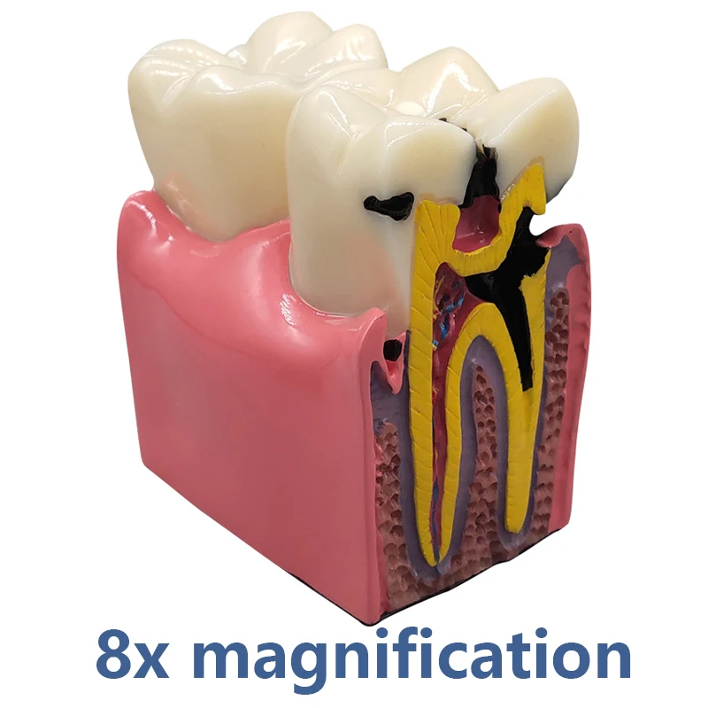 Zahnimplantatmodell, 6/8-fache vergrößerte Karies, kontrastierendes Zahnimplantatmodell, Krone, Zahnimplantatmodelle für Arztpatient-Kommunikation – Detail 11